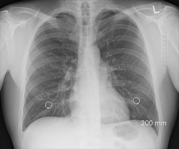 Pneumonia 1 Medicina Integrativă - Abordarea Completă a Sănătății Tale