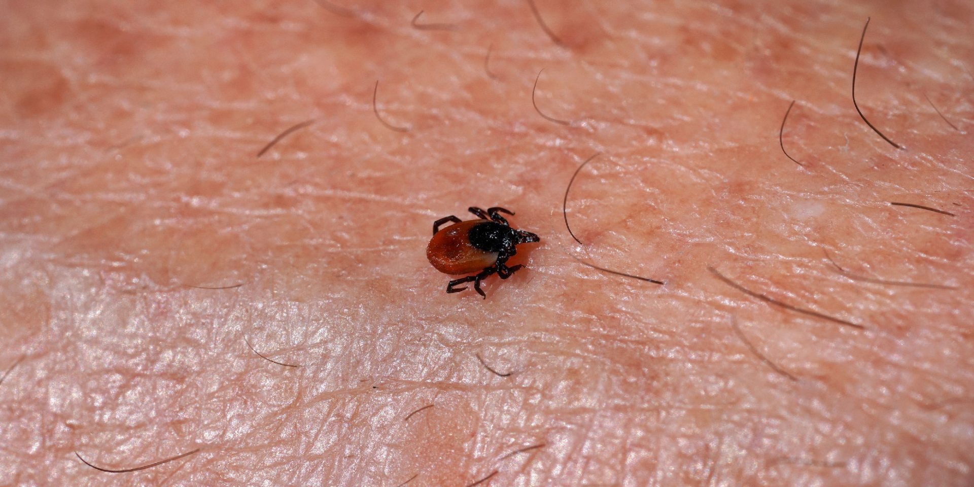 Boala lyme se vindeca? 1 Boala Lyme este o afecțiune bacteriană, transmisă de căpușele din genul Ixodes, insectă care transmite bacteria Borrelia burgdorferi. Persoanele cu boala Lyme pot reactiona la aceasta in mod diferit, iar simptomele pot avea grade diferite de severitate