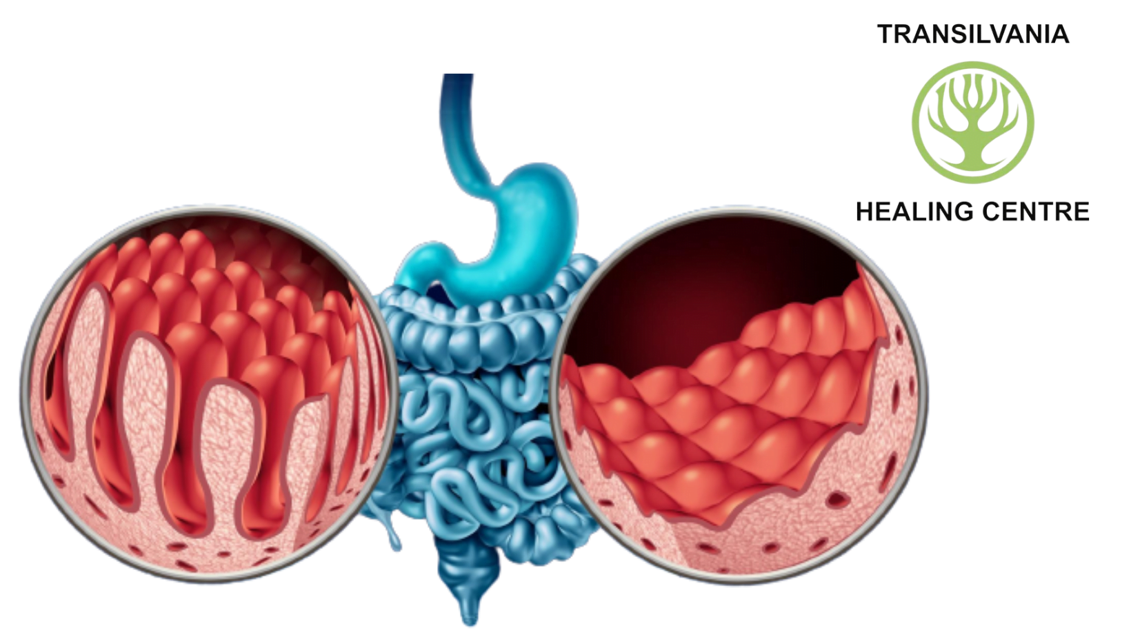 Sensibilitatea la gluten încurajează Boala Celiacă 1 gluten Descopera tot ce trebuie sa stii despre boala celiaca, inclusiv cauzele, simptomele si optiunile de tratament.