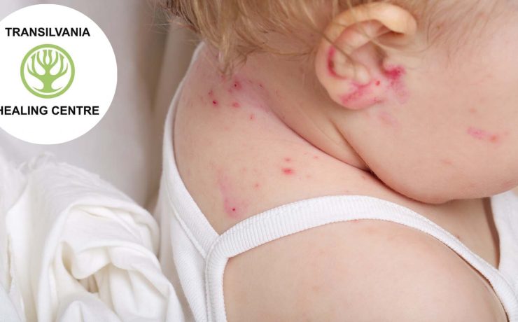 Metode inovatoare de combatere a Dermatitei atopică la copii 2 atopica Combaterea Dermatitei Atopice la Micuții Noștri - Sfaturi și Tratamente Eficiente