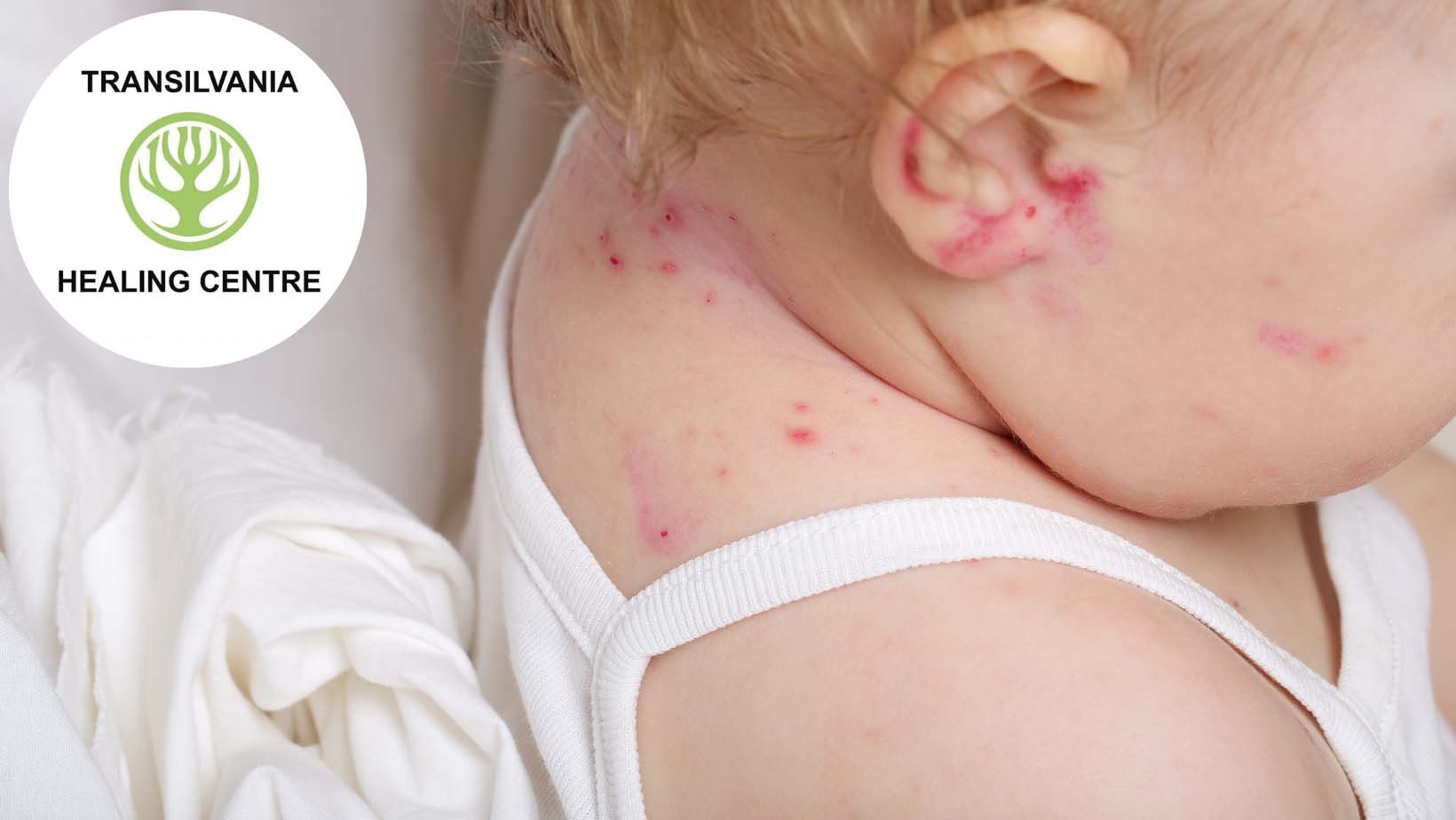Metode inovatoare de combatere a Dermatitei atopică la copii 1 atopica Combaterea Dermatitei Atopice la Micuții Noștri - Sfaturi și Tratamente Eficiente