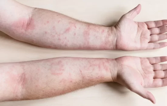 Tot ce trebuie să știi despre dermatită