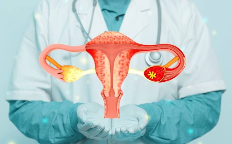 Endometrioză Simptome, Cauze și Soluții pentru Gestionare