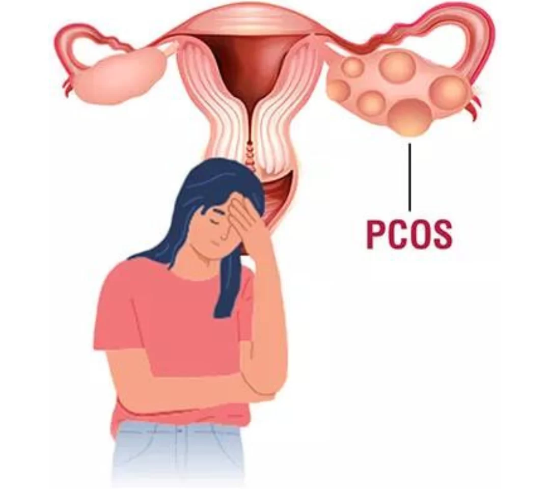 Ovare Polichistice – Cauze, Simptome și Soluții Naturale pentru Echilibru Hormonal